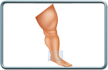 ניתוחי הקרסול- Ankle surgery