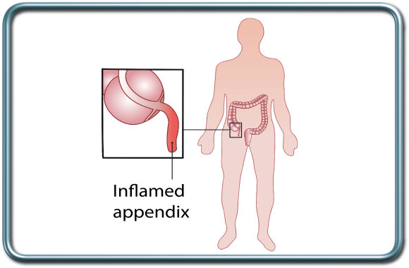 תוספתן מודלק כריתת תוספתן- Appendectomy
