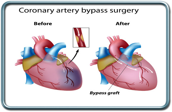 ניתוח מעקפים- CABG