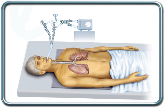 צינור הנשמה דו קני- Double lumen tube צינור הנשמה דו קני