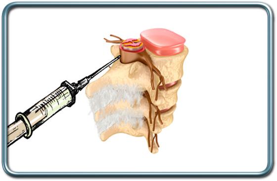 מיקום קצה המחט בחלל האפידורלי לפני קרום הדורה