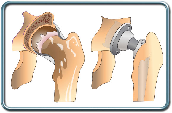 החלפה מלאה של מפרק הירך - total hip replacement החלפת מפרק ירך מלאה- total hip replacement- THR