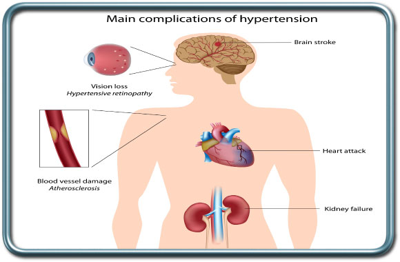 סיבוכי יתר לחץ דם