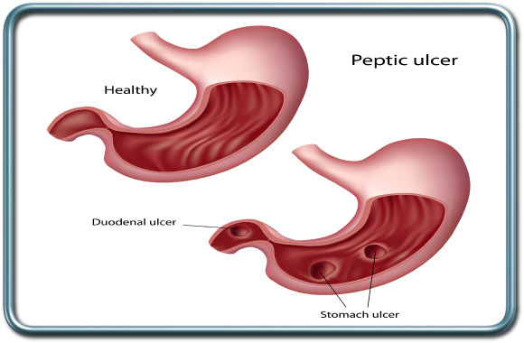 כיב קיבה וקכיב תרסריון- Gastric and duodenal ulcers