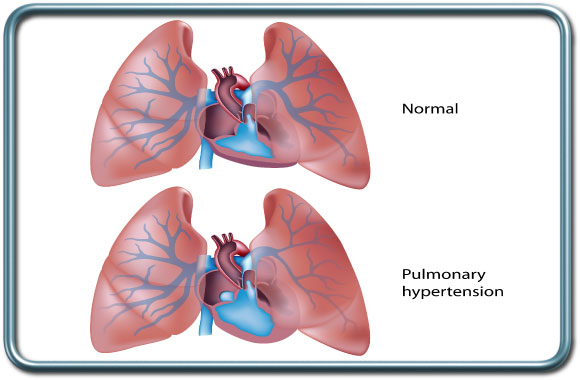 יתר לחץ דם ריאתי