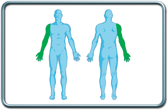 חסם עצבי אינטרסקלני- Interscalene nerve block