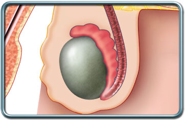 פרוצדורות של האשכים