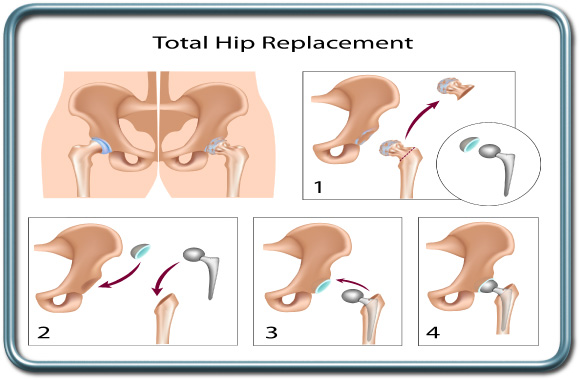 שלבי החלפת מפרק ירך מלאה- Total hip replacement (THR) החלפת מפרק ירך מלאה- total hip replacement- THR